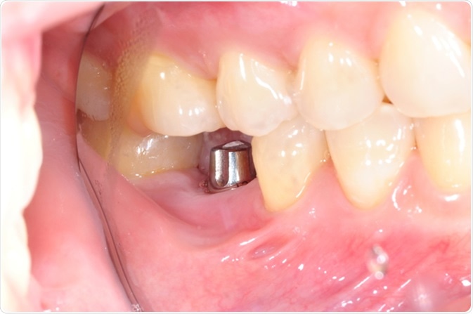 Single tooth implant. Image Credit: Greenbutterfly / Shutterstock